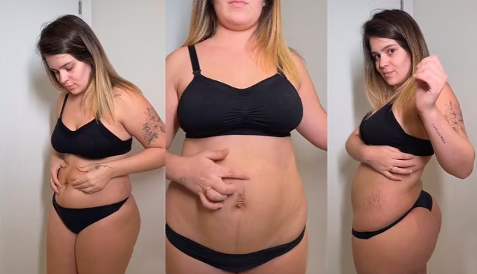 Viih Tube e o Mommy Makeover: a série de cirurgias plásticas pós-parto que reacende o debate sobre corpo e autoestima